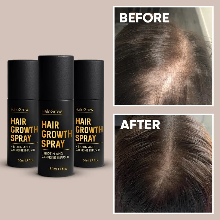 HaloGrow suitability across different causes of hair loss